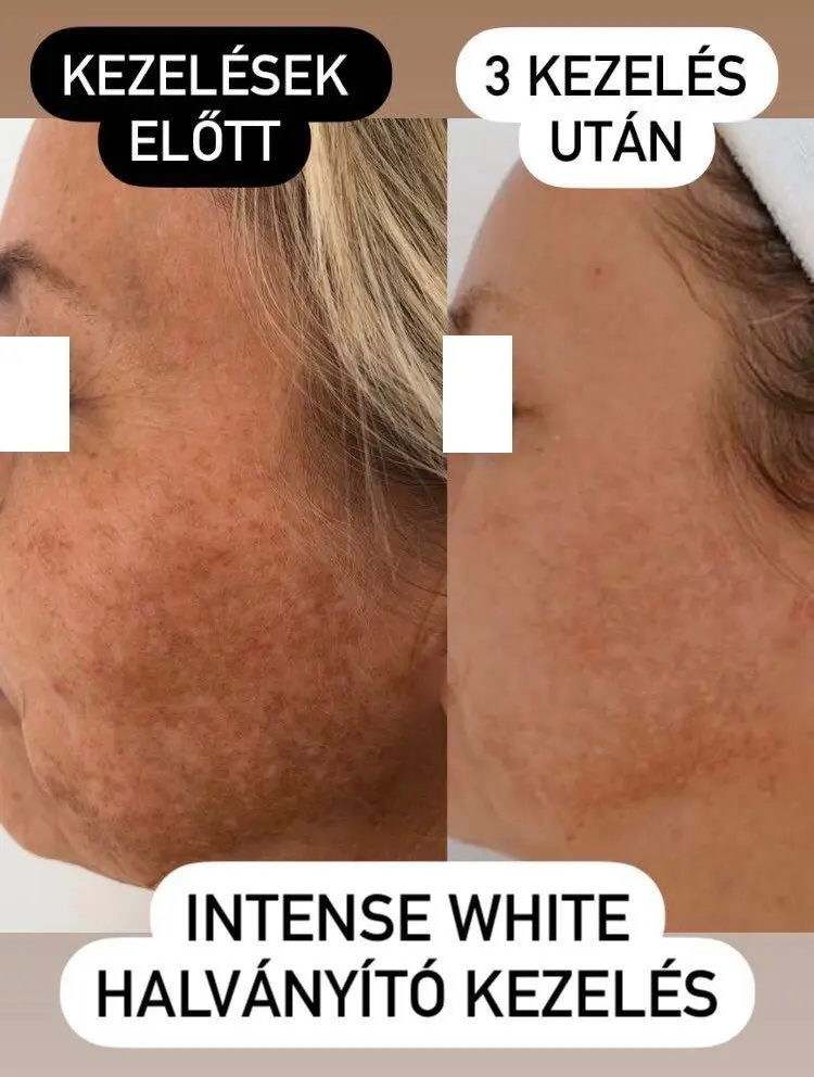 Intense White 3 kezelés